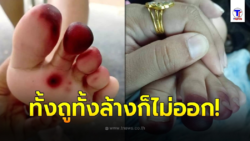 แม่โพสต์เตือนอุทาหรณ์ ต้องเช็ครองเท้าผ้าใบลูกน้อยทุกครั้ง อันตรายที่มากับหน้าฝน