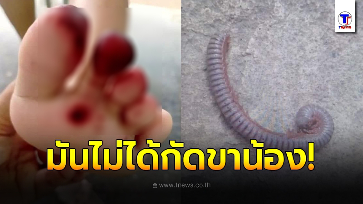 เฉลยแล้ว สาเหตุแผลไหม้แดงเถือกบนเท้าหนูน้อย หลังสัมผัสกิ้งกือที่ซ่อนอยู่ในรองเท้า