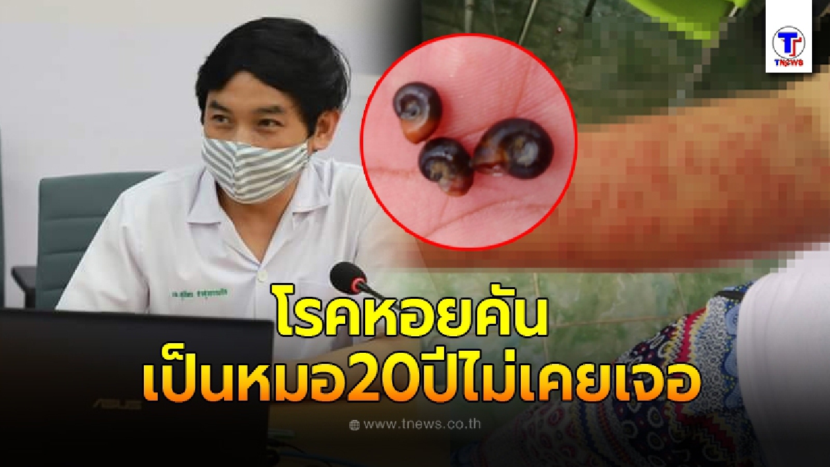 คุณหมอค้นพบโรคหอยคัน หลังชาวบ้าน 223 คน ดำนาผื่นขึ้นแขนขา เป็นหมอมา 20 ปีไม่เคยเจอ