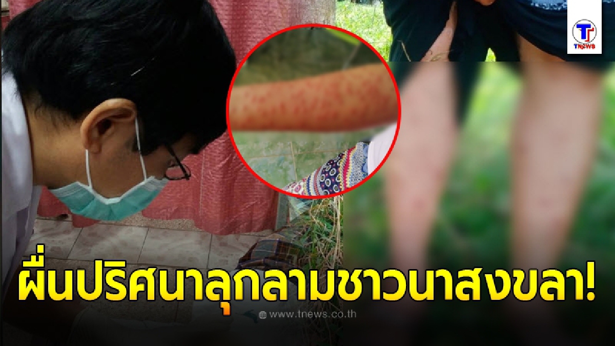 ชาวนาสงขลาถึงผวา ดำนาเสร็จเกิดผื่นปริศนาขึ้นเต็มแขน - ขา ผอ.รพ.จะนะ เร่งตรวจสอบทันที