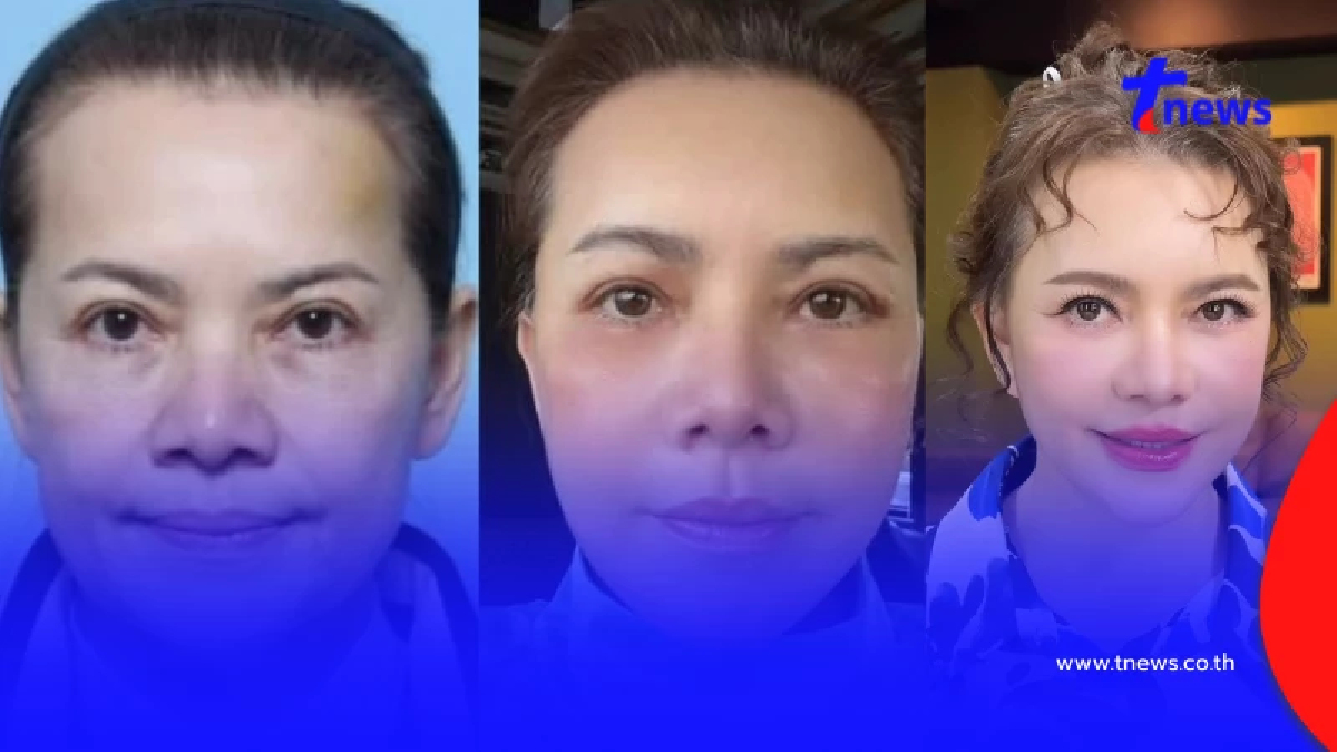 พิธีกรดัง โชว์หน้าใหม่หลังศัลยกรรม 1 เดือน สวยเป๊ะ เด็กลงมาก