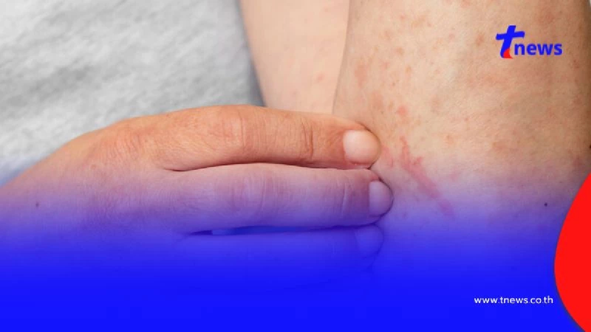 ตกใจ เผยกลุ่มอายุติดเชื้อ เอชไอวี - ซิฟิลิส มากสุดในไทย