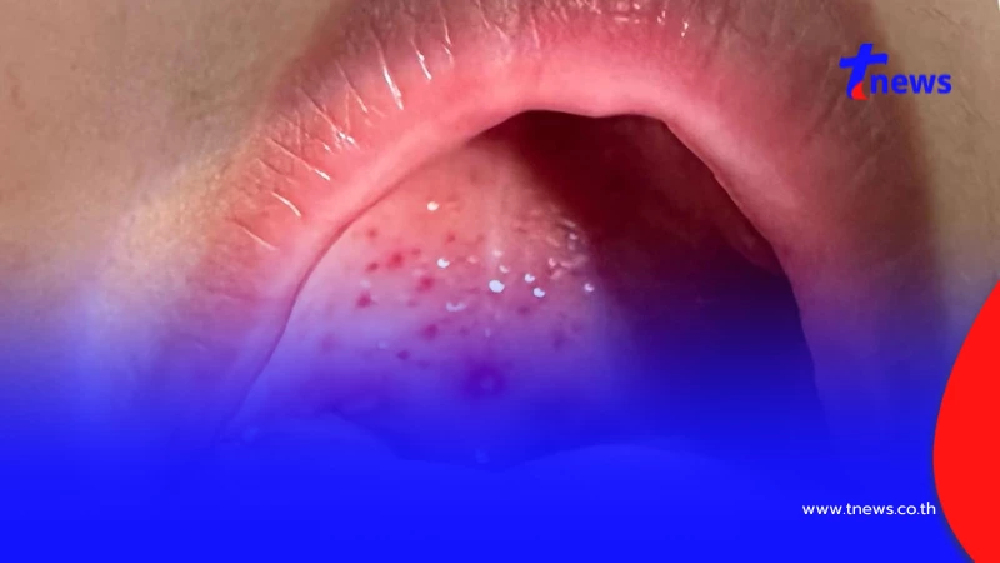 มือเท้าปาก-เฮอร์แปงไจน่า ระบาดซ้ำ หมอแนะฉีดวัคซีนด่วน