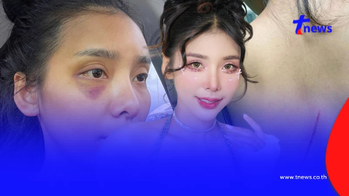 "แอน แสงทอง"ถูกคนรักทำร้าย สภาพจิตใจแย่ เจ็บนี้ไม่มีวันลืม