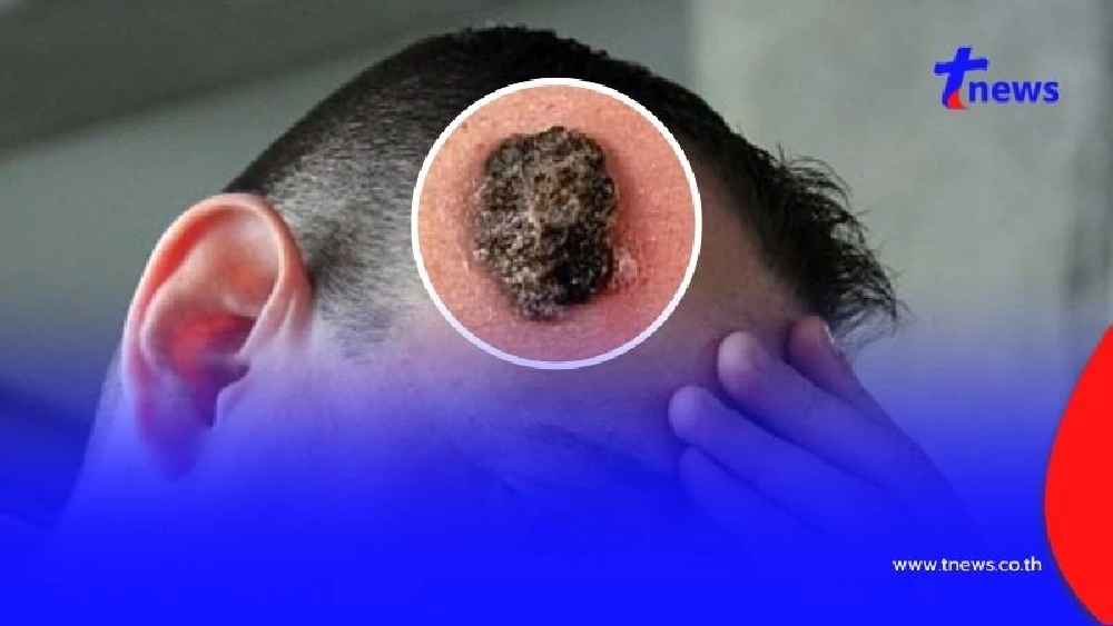 ปวดหัวไม่หาย ต้องระวัง ชายวัย42 ปวดหัวนานนับเดือน ตรวจพบไฝมะเร็ง