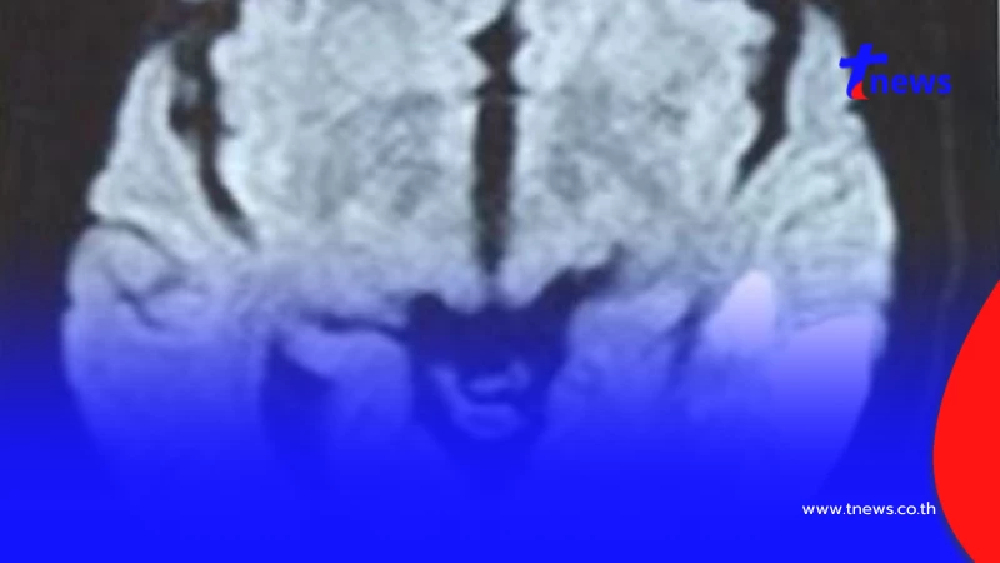 หมอดัง เผยเคสแปลก คนไข้ตื่นมาพูด ภาษาต่างดาว ที่แท้สัญญาณอันตราย