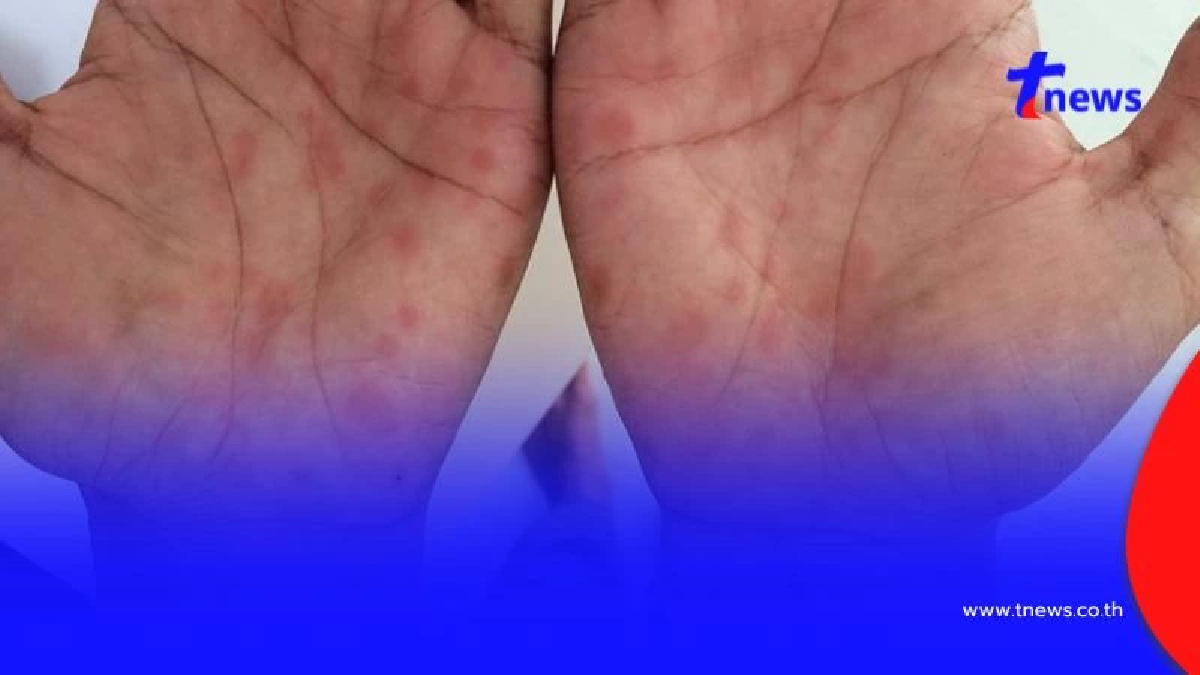 เปิด 10 อำเภอเจอป่วย ซิฟิลิส สูงสุด ยอดสะสมพุ่งทะลุหลักหมื่น