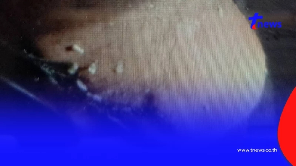 ลุงวัย 59 จู่ๆ มีหนอนไต่ออกมาตามตัว รู้ว่าไปทำอะไรมาน่าเห็นใจ