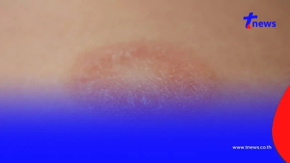 "ผื่นกลีบกุหลาบ"  โรคผิวหนังที่เกิดจากเครียดสะสม นอนน้อย