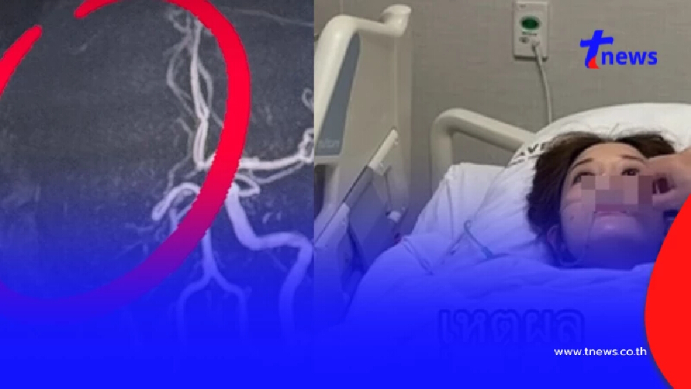 สาวเฉียดตาย พักผ่อนน้อย ใช้ชีวิตหนัก Strokeมาเยือน 1ในแสนที่รอด