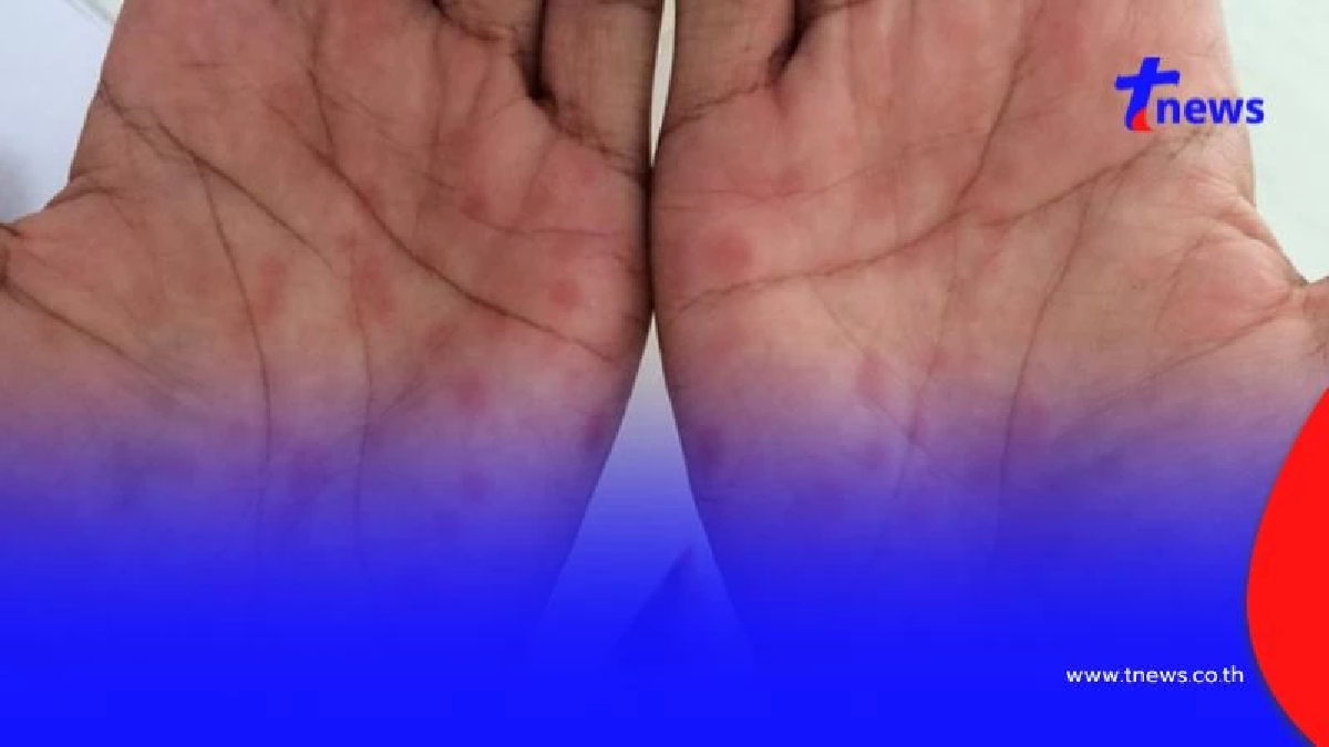 เปิด 5 จังหวัด ซิฟิลิสพุ่งกว่า 2.9 เท่า พ่อแม่วัยใสรับความเสี่ยง