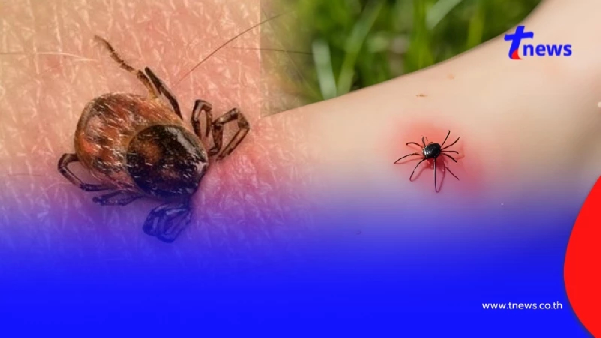 ของจริง โดน "เห็บกัด" เสี่ยงถึงขั้นเสียชีวิตจากเชื้อไวรัส