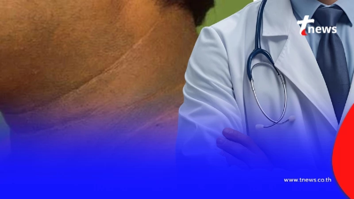 เปิดความจริง อาการ "คอดำ" ขัดยังไงก็ไม่ออก ใครเป็น ไปหาหมอด่วน