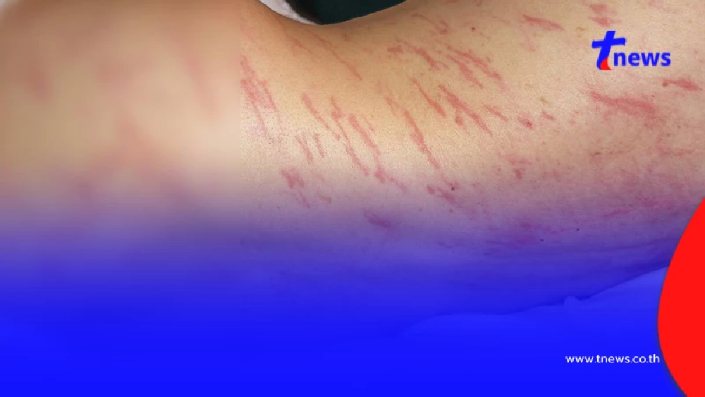 ขนลุก ชายวัย 64 ป่วยมะเร็ง มีผื่นแดงลามทั่วตัว รู้สาเหตุยิ่งตกใจ