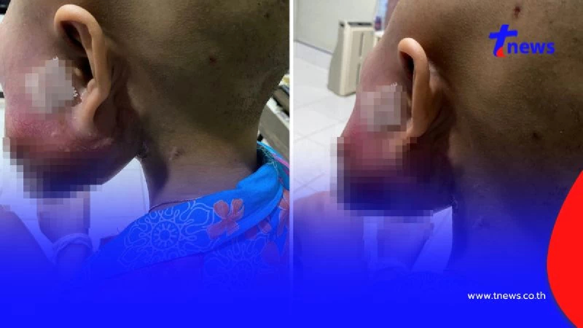 วอนช่วยเหลือ "เด็กหญิง16" ป่วยมะเร็งกระดูกรุนแรง ไม่ตอบสนองคีโม