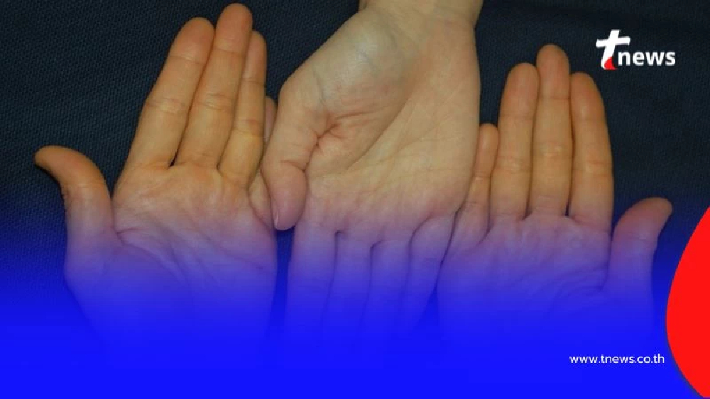 เตือนภัยเงียบ ผิวเหลืองเมื่อแก่ อาจไม่ใช่แค่ชราภาพธรรมดา