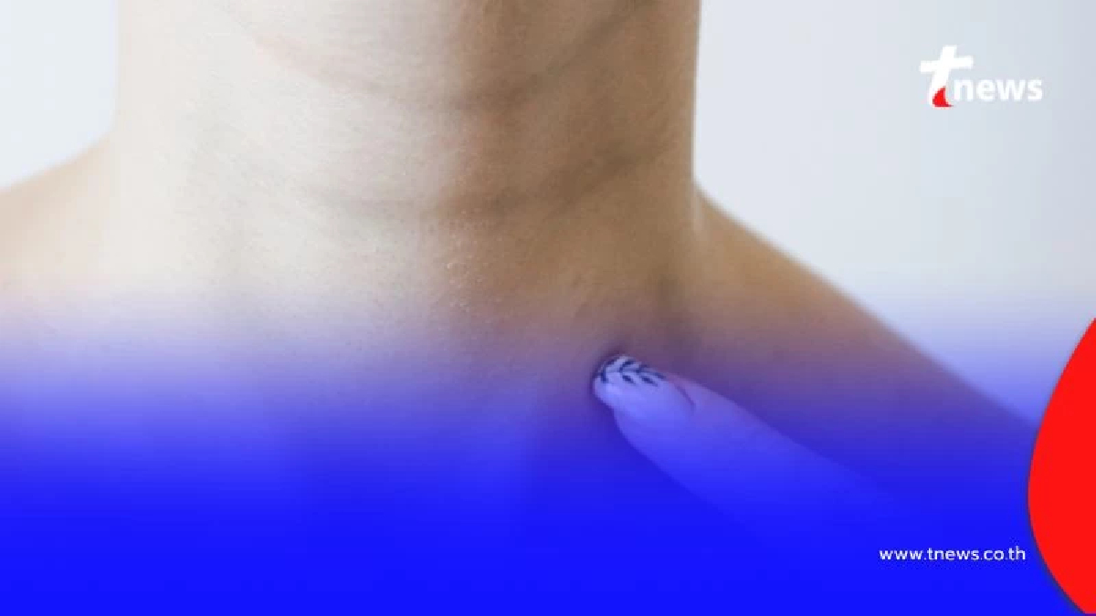 วิธีสังเกตก้อนที่คอ แบบไหนควรไปหาหมอโดยเร็วที่สุด วันนี้มีคำตอบ