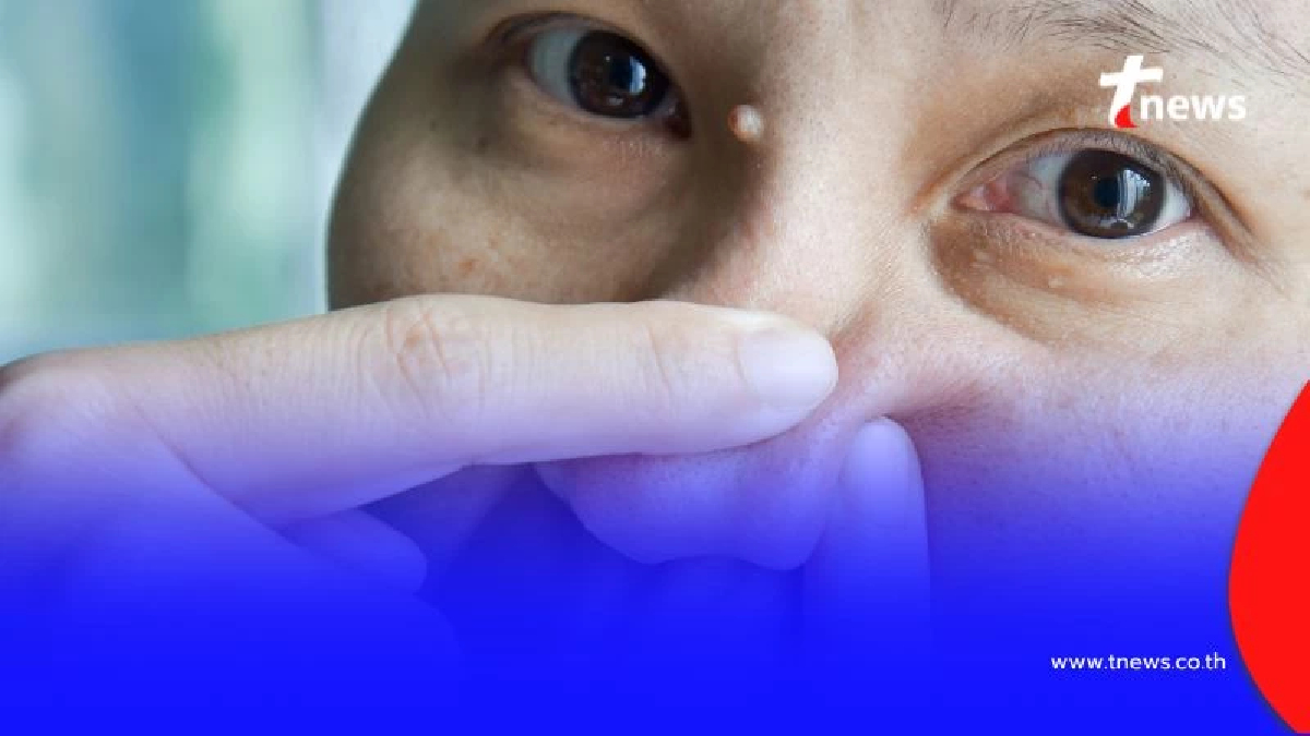 สิวที่จมูกไม่ใช่แค่เรื่องสิวๆ แต่อาจทำให้สมองติดเชื้อ อันตรายถึงชีวิต