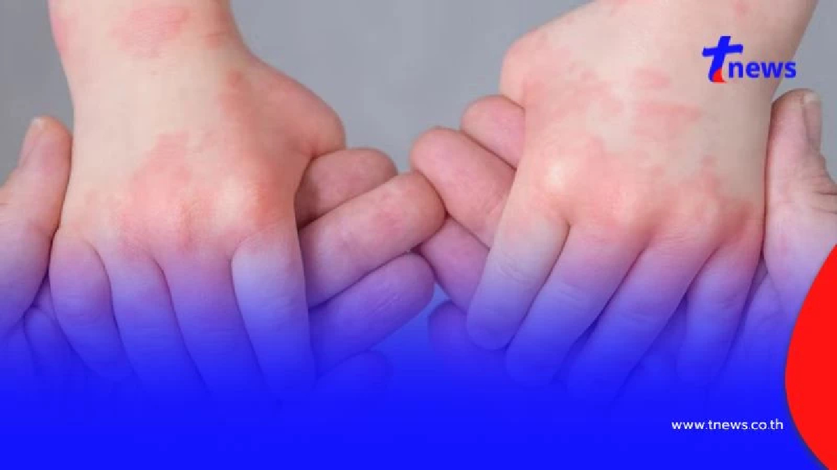 โรคมือ เท้า ปาก ในเด็ก อันตรายกว่าที่คิด รู้เท่าทันก่อนสายเกินไป