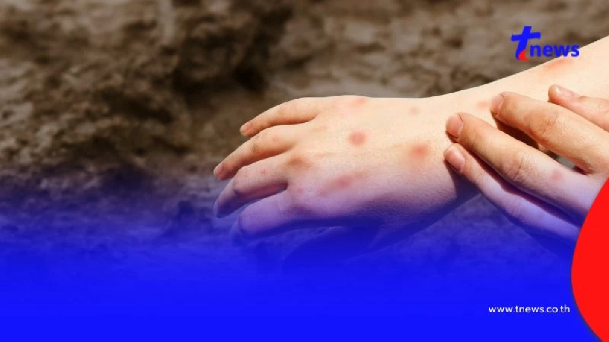 "โรคไข้ดิน" เปิดอาการสาเหตุติดเชื้อ หลังพบระบาด ดับแล้ว 92 ราย