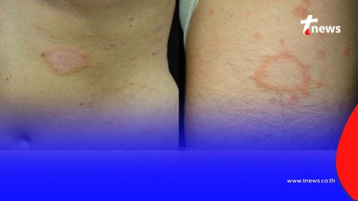 ทำความรู้จัก โรคผื่นกุหลาบ คืออะไร สัญญาณเตือนที่คนท้องต้องรู้