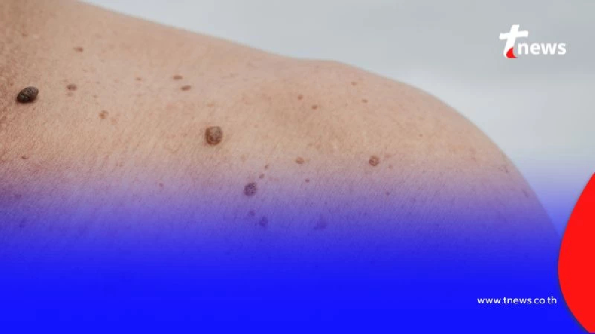 หมอเตือน 5 สัญญาณอันตรายของ 'ไฝ' ที่อาจกลายเป็นมะเร็งผิวหนัง