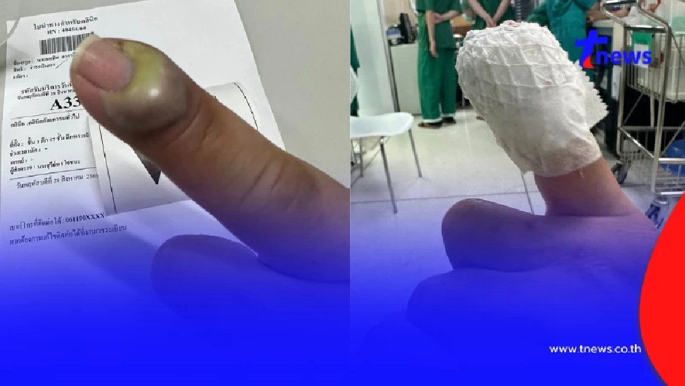 หนุ่มหวิดโดนตัดนิ้ว แผลเล็ก ๆ จากแมวข่วน เตือนอย่าชะล่าใจ