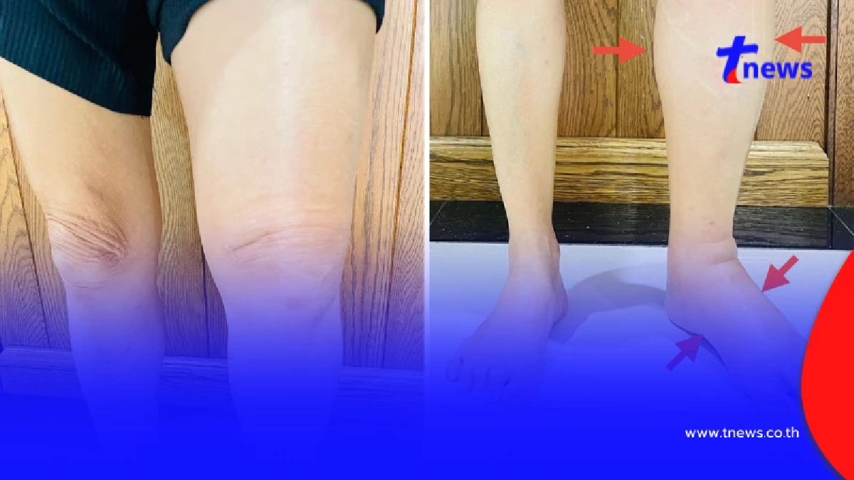 ชายขาซ้ายบวมถึงเท้า หมอเผยสาเหตุ เตือนรีบรักษา อันตรายถึงชีวิต
