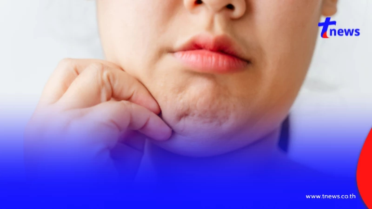 วงการแพทย์ทึ่ง!เทคนิค "ตัดเหนียงส่องกล้อง" ทางเลือกใหม่ของคนอยากหน้าเรียว