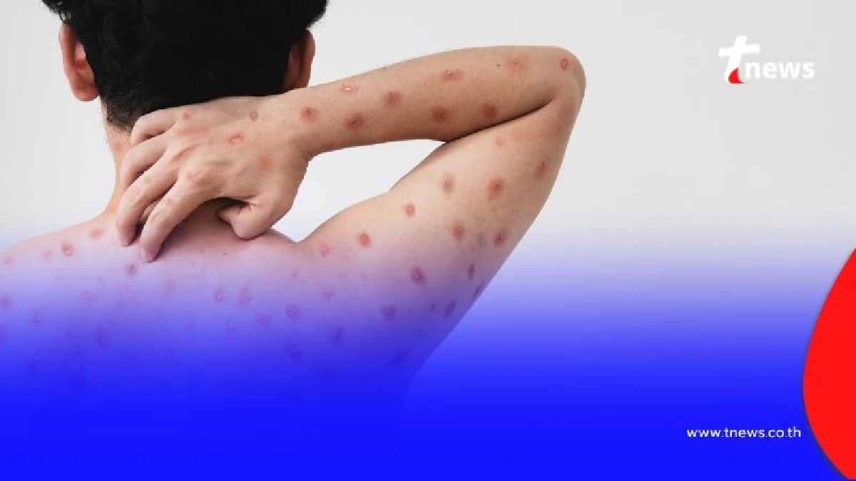 เตือนภัย โรคฝีดาษวานรกลับมาระบาดในไทยอีกครั้ง พร้อมวิธีป้องกันที่ต้องรู้