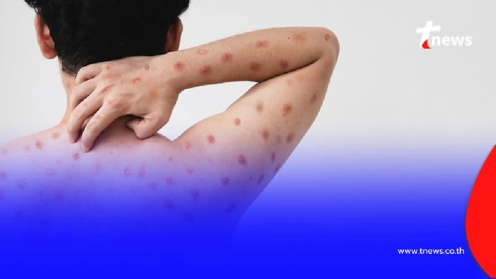 เตือนภัย โรคฝีดาษวานรกลับมาระบาดในไทยอีกครั้ง พร้อมวิธีป้องกันที่ต้องรู้
