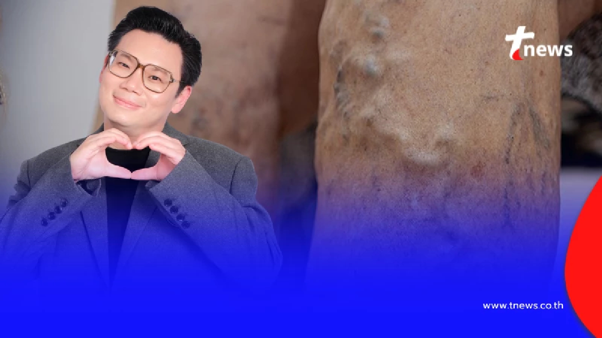 "หมอเจด" เตือนเอง "เท้าบวม เส้นเลือดปูด" ผู้สูงอายุระวังด่วน