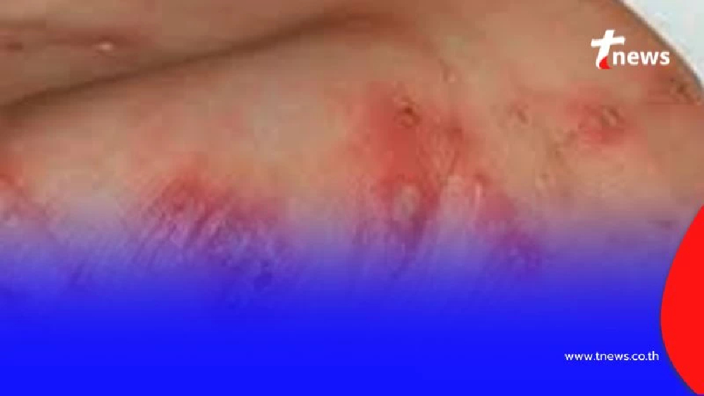 “ไข้รากสาดใหญ่” โรคร้ายที่เริ่มต้นจากรอยคล้ายบุหรี่จี้ และอาจอันตรายถึงชีวิต