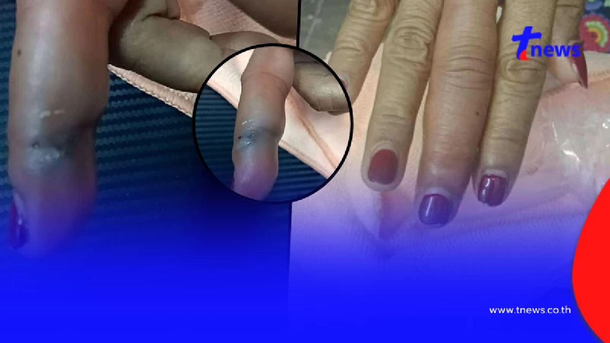 หญิงทำกับข้าว ถูกเปลือกกุ้งทิ่มมือ สุดท้ายติดเชื้อรุนแรง