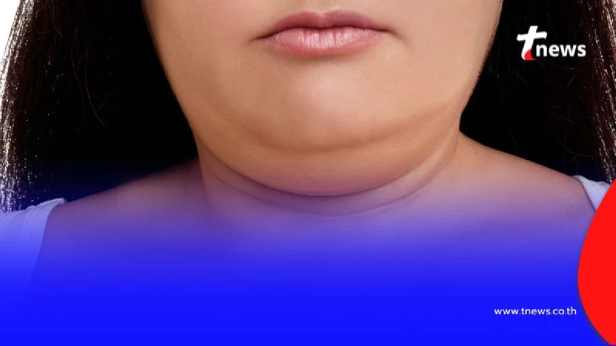 5 วิธีลดเหนียงที่คอแบบธรรมชาติ ทำเองได้ ไม่ต้องพึ่งหมอ