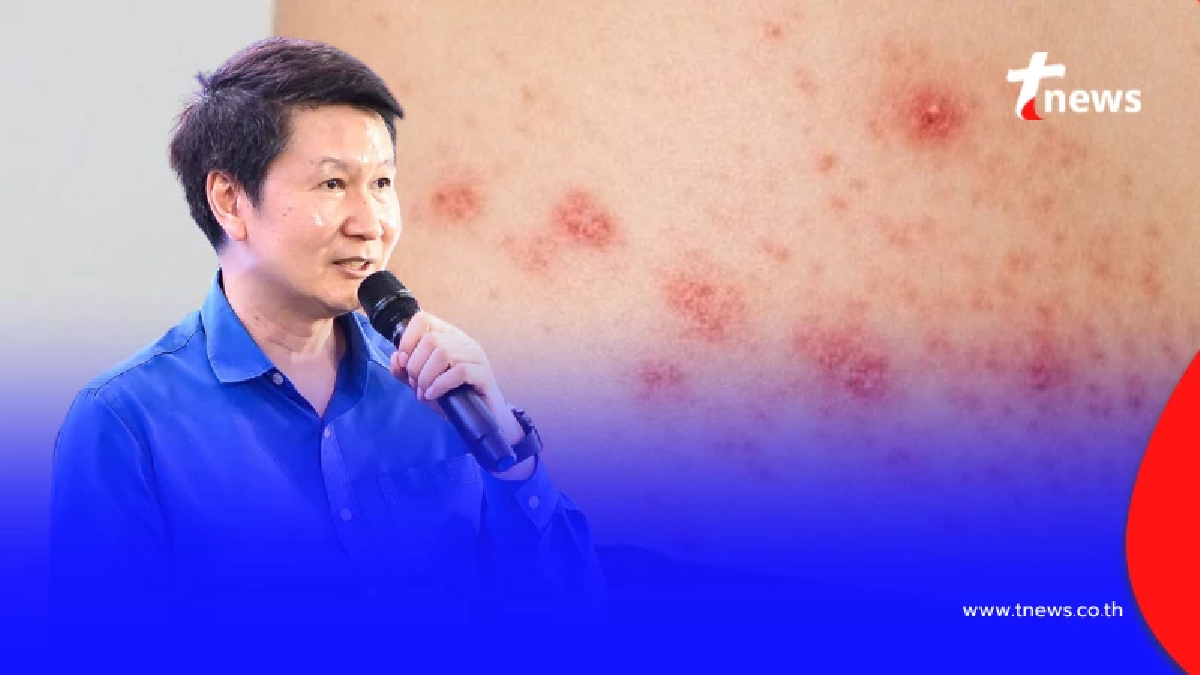 รู้แล้ว "โรคงูสวัด" ถ้าขึ้นรอบเอว จะเสียชีวิต จริงหรือไม่