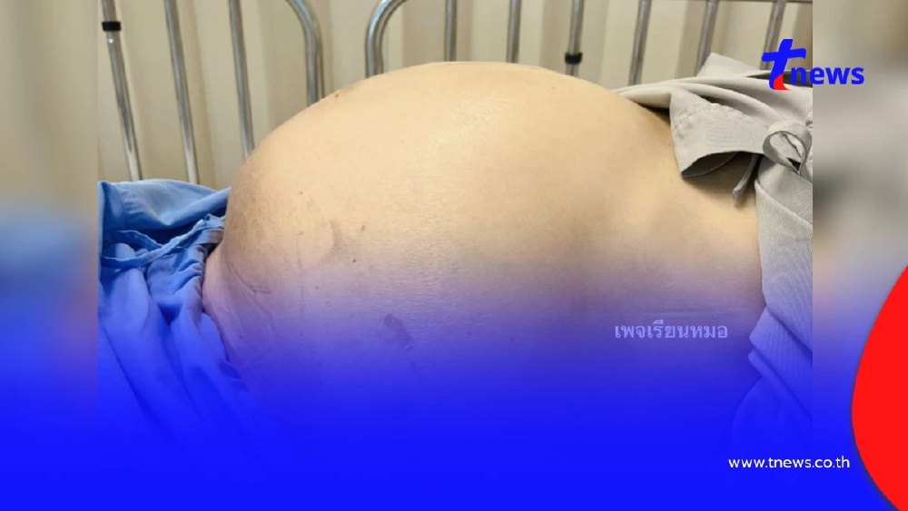 หญิงวัย 60 ท้องมานโต สุดท้ายเป็นมะเร็งท่อน้ำดี รู้ของที่ชอบกินยิ่งตกใจ