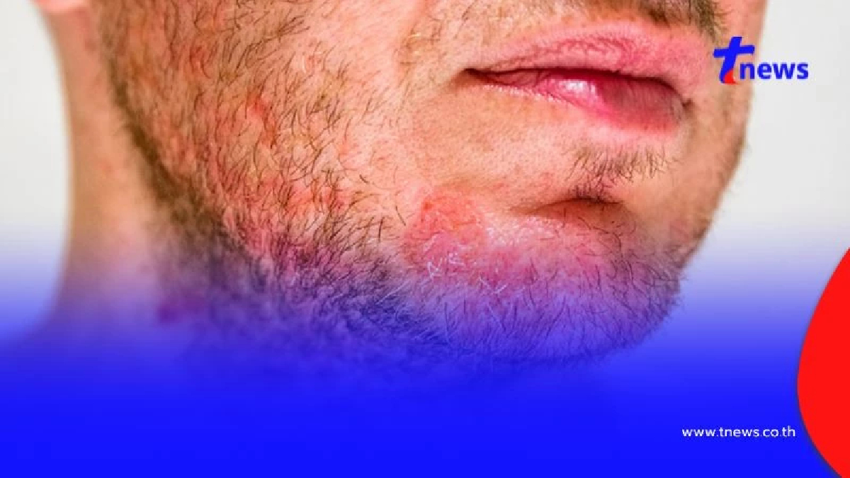 หน้าฝนต้องระวัง! 3 โรคผิวหนังเสี่ยงติดง่าย จากเชื้อราและแบคทีเรีย