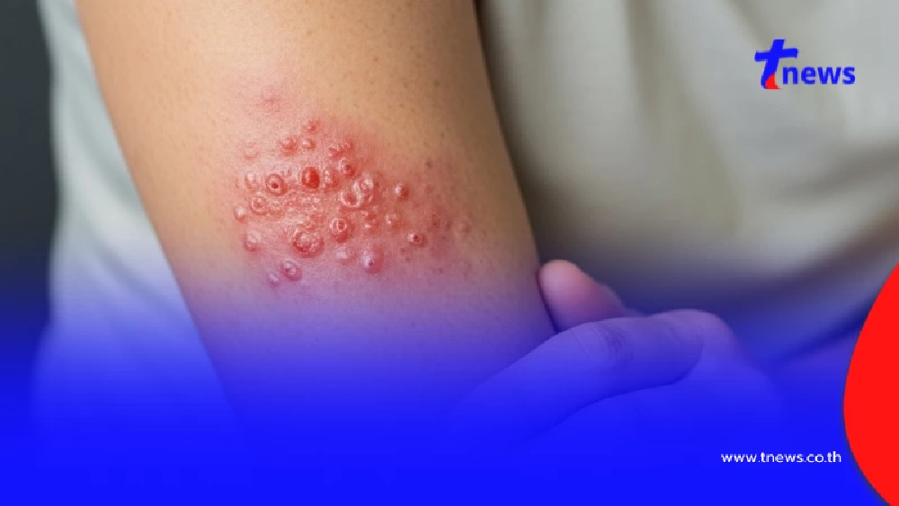 แม่ค้าผักป่วยเริมงูสวัด หมอพื้นบ้าน พ่นหมากพลูใส่ ผลลัพธ์สุดพีก