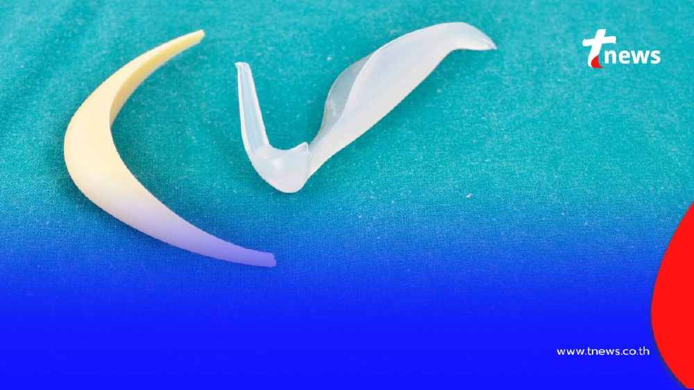 เตือนภัยศัลยกรรม ซิลิโคนเถื่อนเสี่ยงติดเชื้อต้องใช้ ซิลิโคนเกรดแพทย์ ที่ผ่าน อย. เท่านั้น