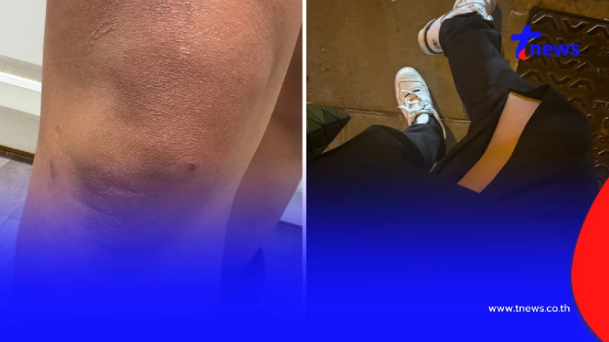 คนไทยในอังกฤษ เล่านาทีชีวิต ถูกผลักให้รถบัสชน แจ้งตำรวจยังเงียบ