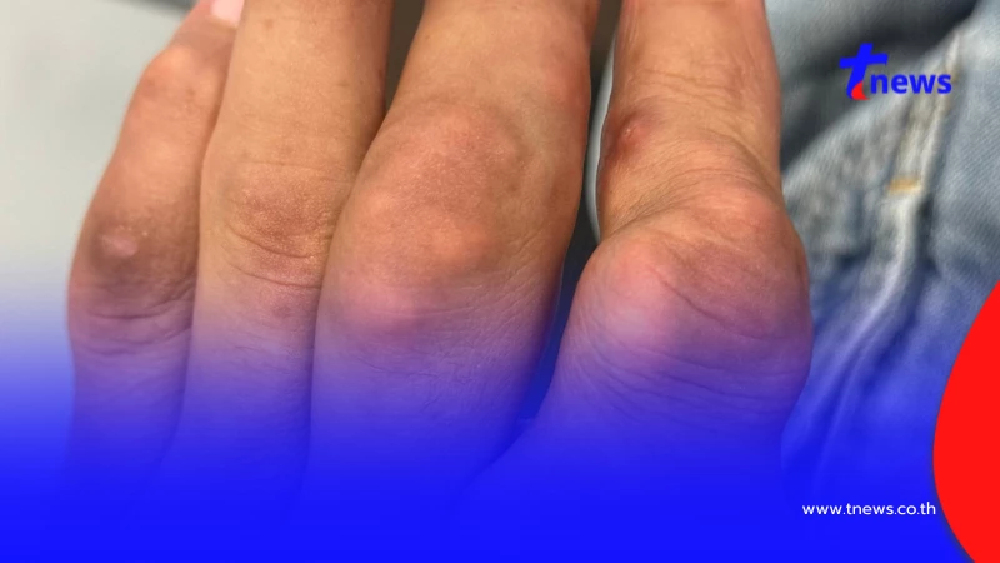 ปวดข้อ สู่ก้อนแข็งใต้ผิว หมอไขปริศนา "โทฟัส" ภัยเงียบโรคเก๊าท์