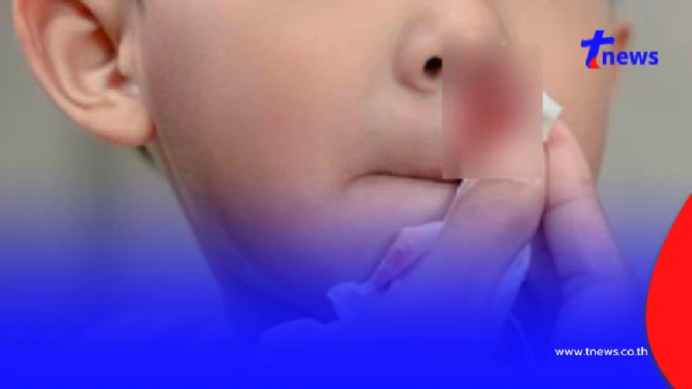 เตือนพ่อแม่ เคสเด็ก7ขวบ เลือดกำเดาไหลไม่หยุด ซักประวัติเจอเต็ม ๆ