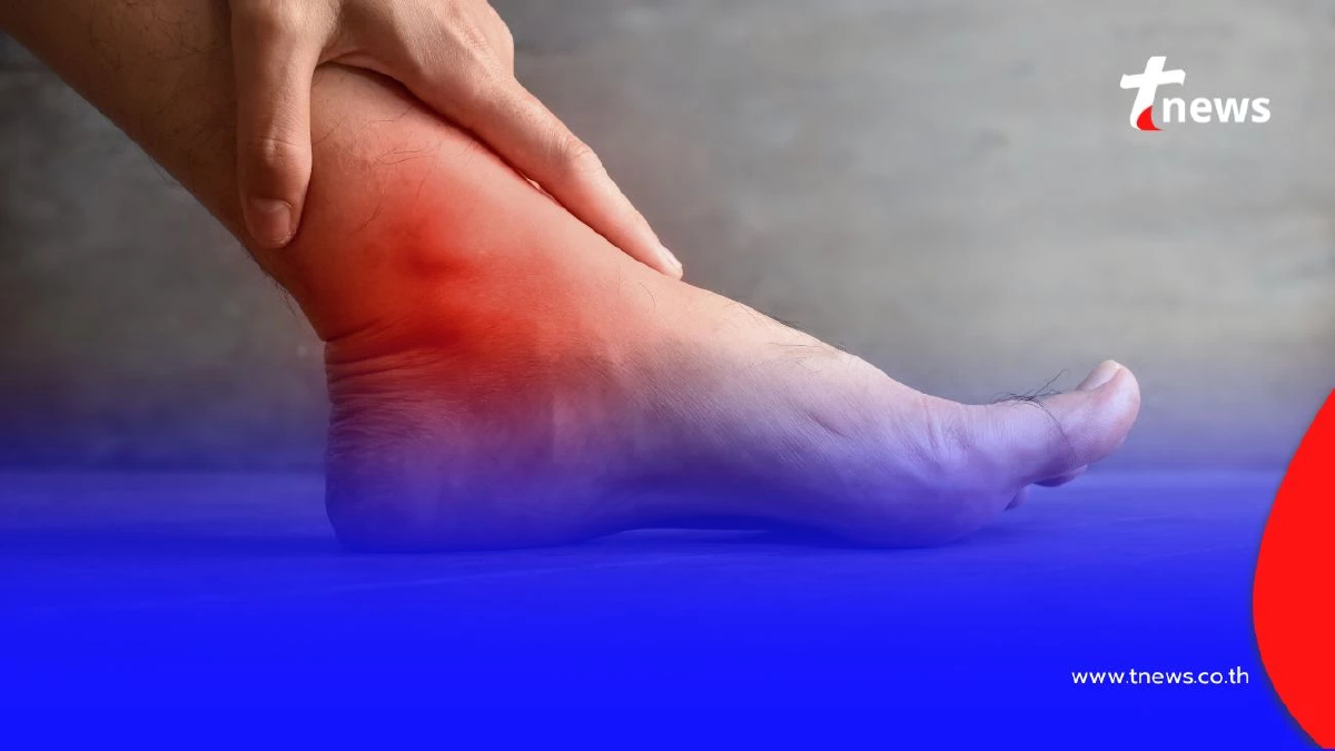 ไขข้อสงสัย ทำไม "กินไก่เยอะ" ถึงเสี่ยงเป็นโรคเกาต์ วันนี้มีคำตอบ