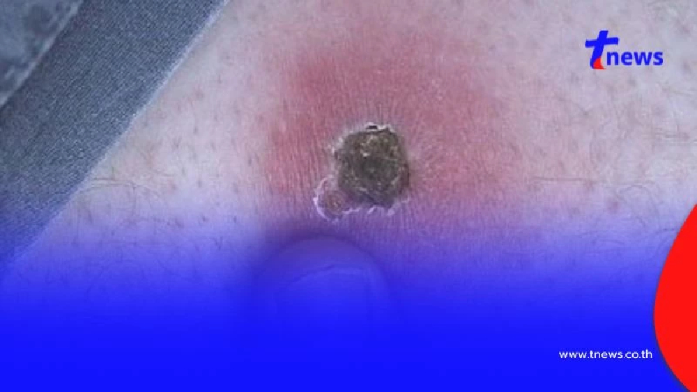 สายแคมป์ต้องระวัง! “ไข้รากสาด” ระบาดในช่วงหน้าฝนอย่าประมาทเวลาเข้าป่า