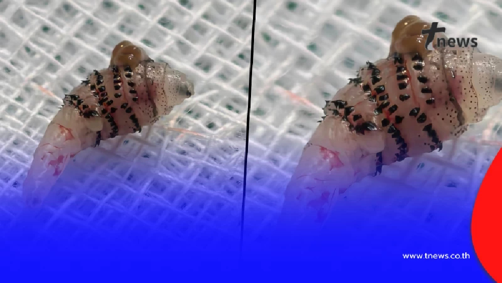 สุดสยอง รู้แล้ว "ตัวอะไร" อยู่ใต้ผิวหนัง คนไข้ชาวต่างชาติ