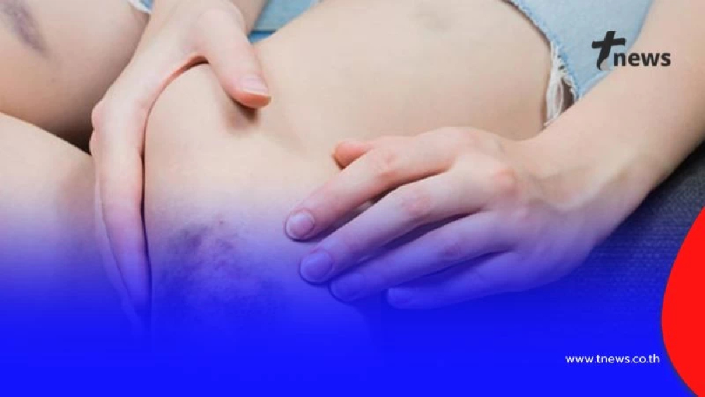 4 วิธีรักษารอยช้ำให้หายไว เผยผิวกลับมาเนียนใส ไม่ทิ้งรอยให้กวนใจ