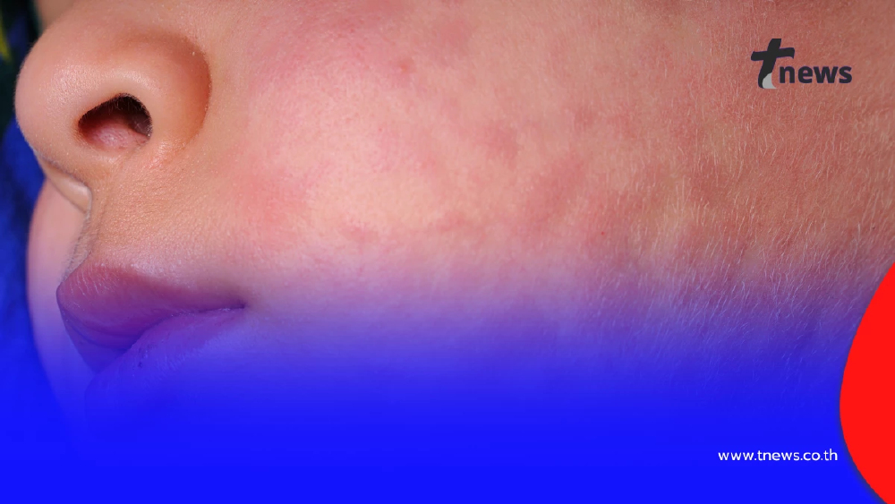 เด็กเสี่ยงสูง! รัฐบาลชี้เชียงรายชายแดนเฝ้าระวังโรคหัด