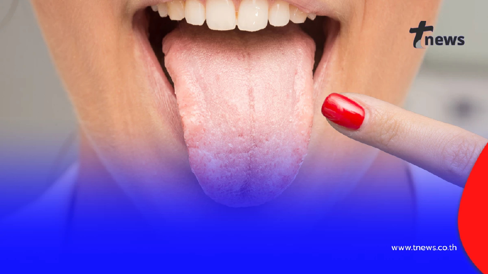 อย่ามองข้าม “ลิ้น” กระจกสะท้อนสุขภาพ ที่หลายคนไม่เคยสังเกต