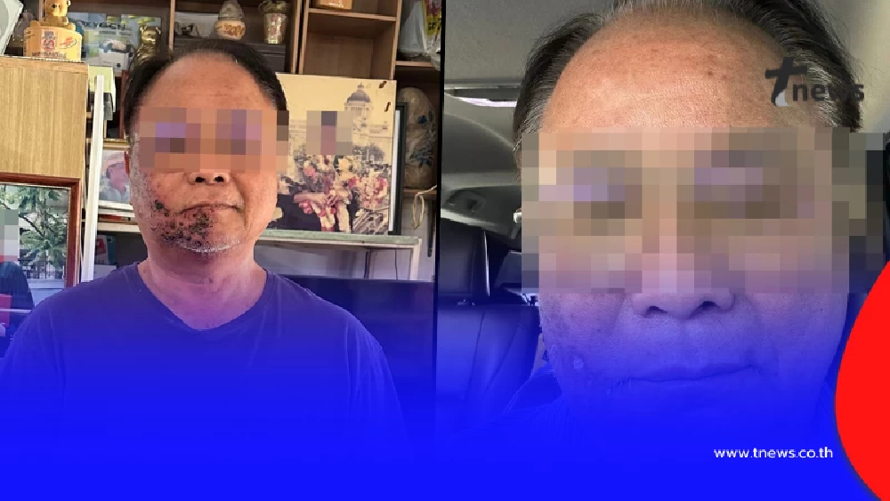 อุทาหรณ์ชั้นดี หมดเงินเฉียดล้าน เหตุเพราะเป็น "โรคงูสวัด"